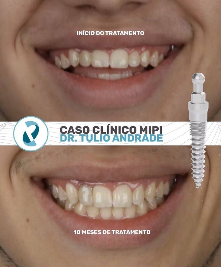 CASO CLINICO MIPI – Dr. Tulio Andrade
