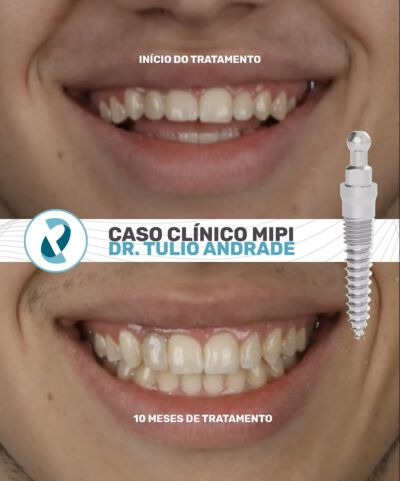 CASO CLINICO MIPI – Dr. Tulio Andrade